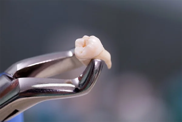 Removal of Wisdom Tooth