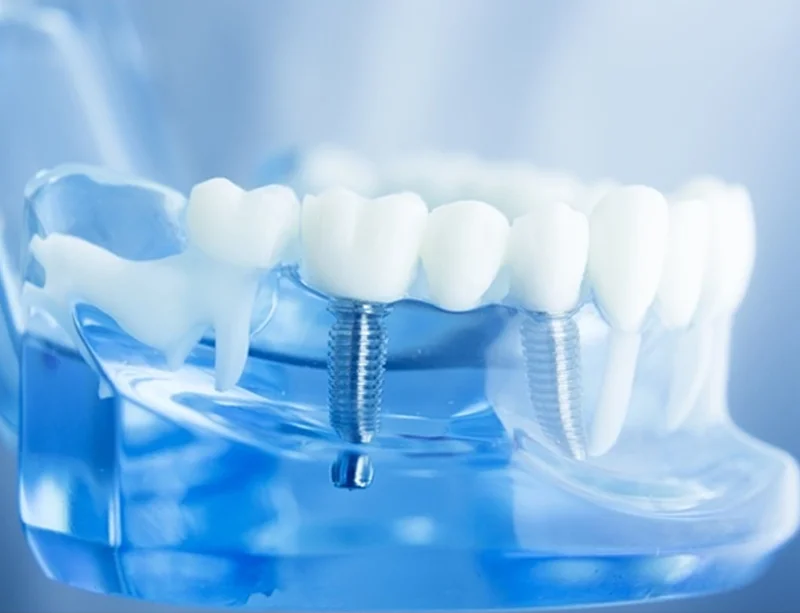 All on Four Implants with Dentures