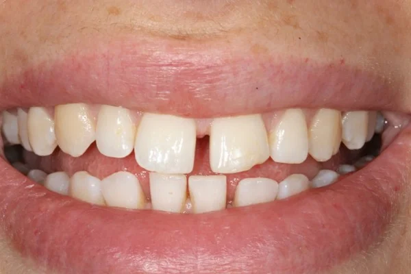 Gap Closure