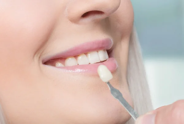 Emax Veneers for Cosmetic Rehabilitation